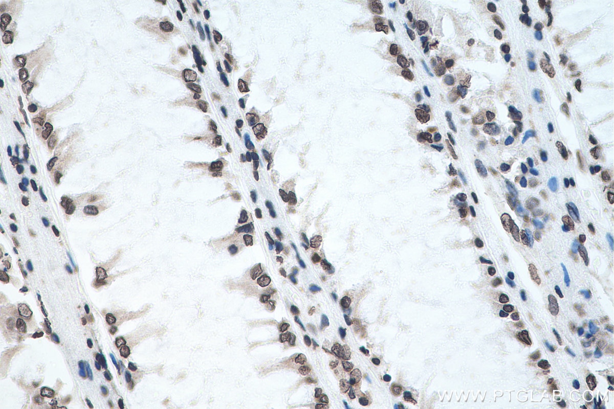 Immunohistochemistry (IHC) staining of human colon cancer tissue using m6A Monoclonal antibody (68055-1-Ig)