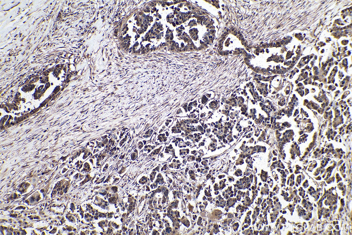 Immunohistochemistry (IHC) staining of human colon cancer tissue using m7G Monoclonal antibody (68302-1-Ig)