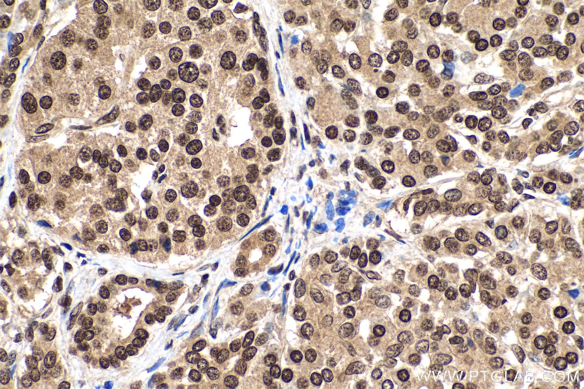 Immunohistochemistry (IHC) staining of human pancreas cancer tissue using m7G Monoclonal antibody (68302-1-Ig)