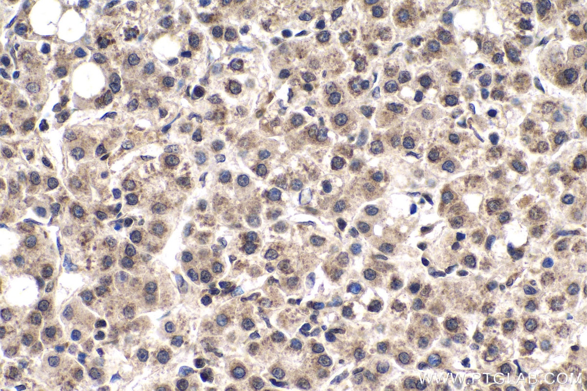 Immunohistochemistry (IHC) staining of human liver cancer tissue using m7G Monoclonal antibody (68302-1-Ig)