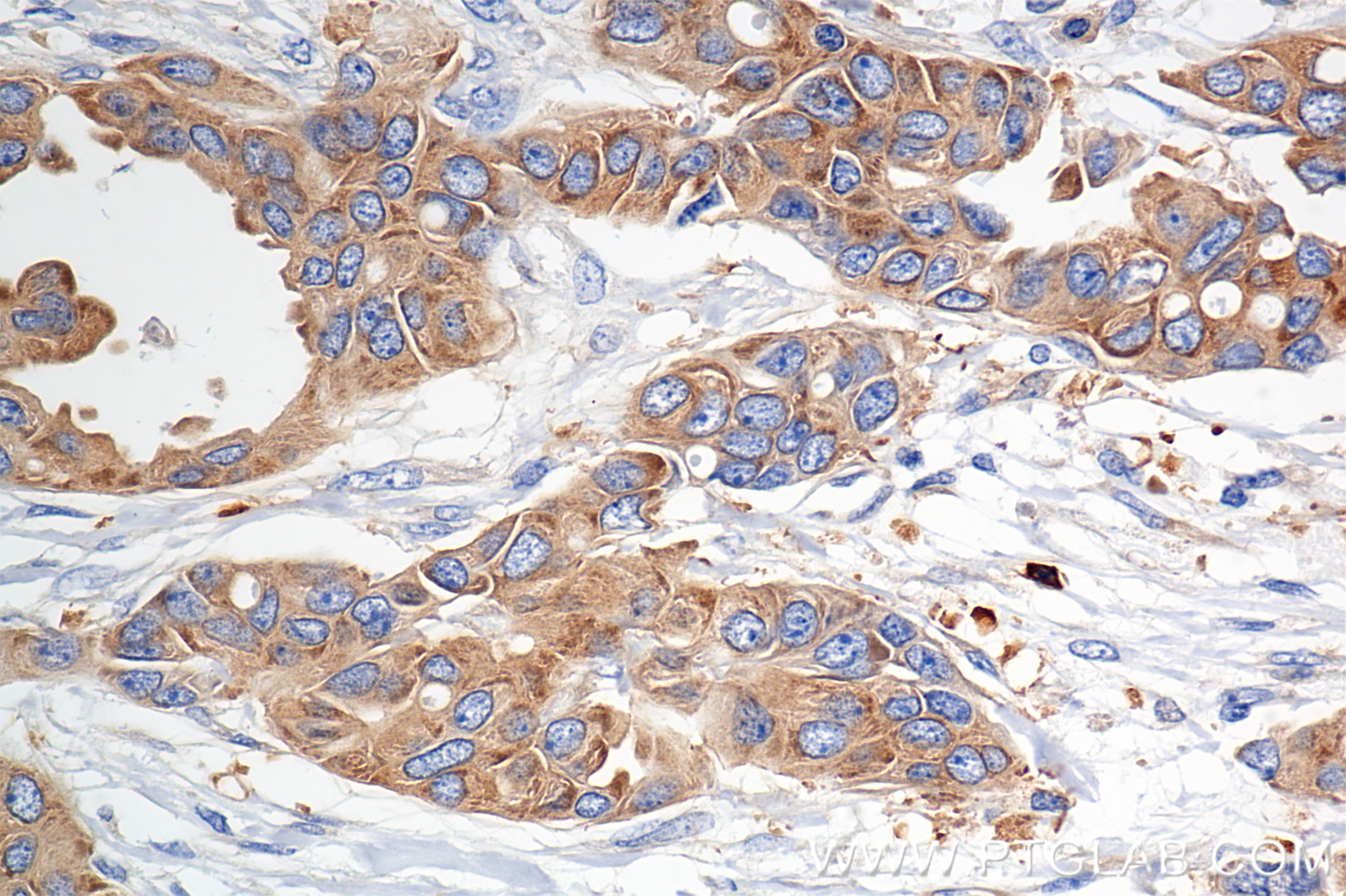 Immunohistochemical analysis of paraffin-embedded Human Breast Cancer(Her2+;ER-;PR-) slide using 85708-2-RR (mDia1 antibody) at dilution of 1:1000 (under 40x lens). Heat mediated antigen retrieval with Tris-EDTA buffer (pH 9.0). Immunohistochemistry (IHC) staining of Human Breast Cancer(Her2+;ER-;PR-) using mDia1 Recombinant monoclonal antibody (85708-2-RR)
