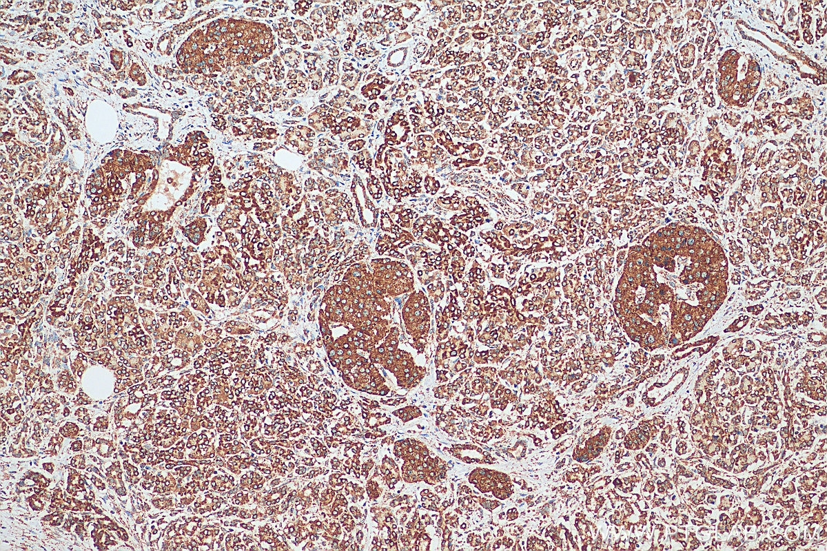 Immunohistochemistry (IHC) staining of human pancreas cancer tissue using CISD1 Polyclonal antibody (16006-1-AP)