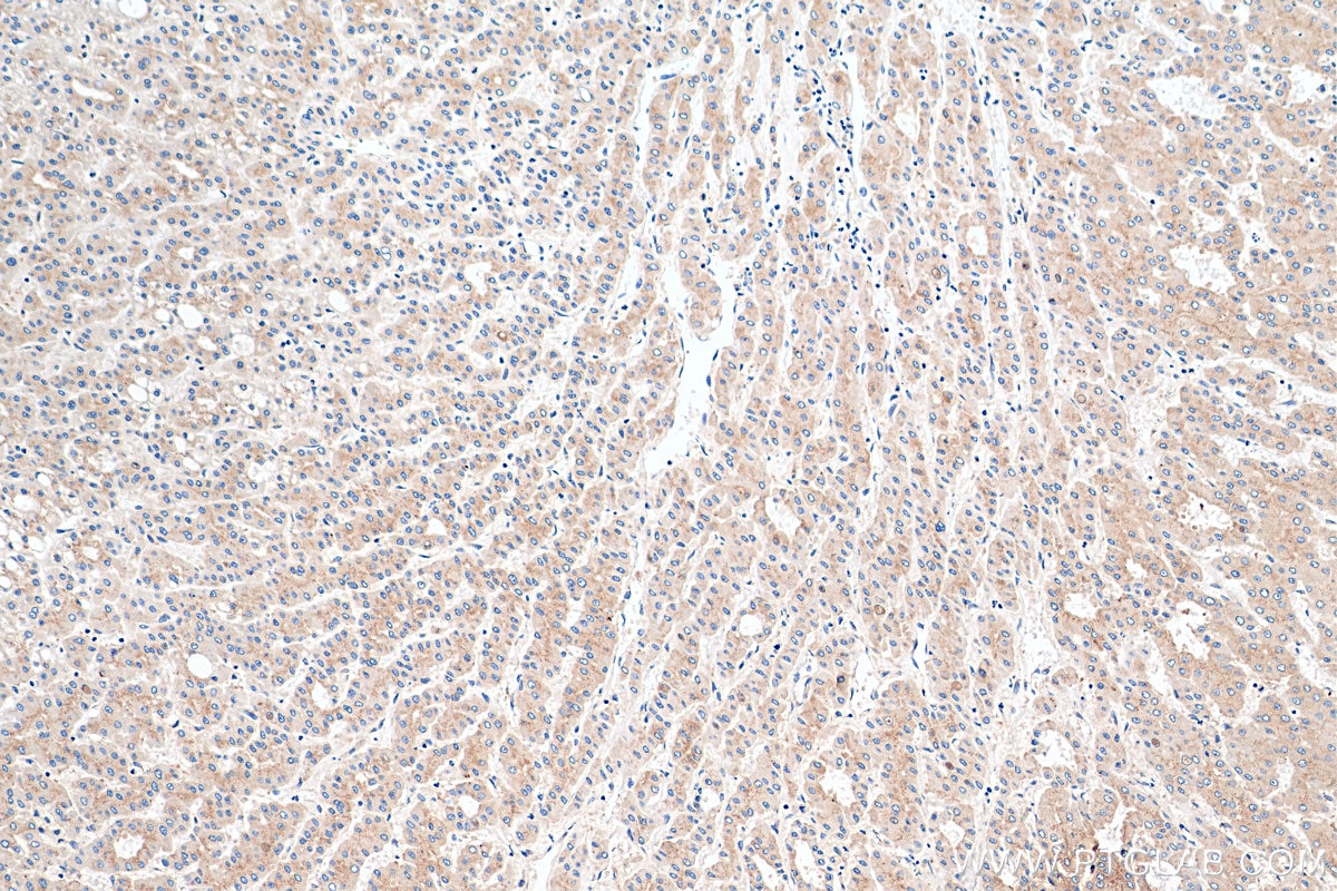 Immunohistochemistry (IHC) staining of human liver cancer tissue using p115, USO1 Monoclonal antibody (68100-1-Ig)