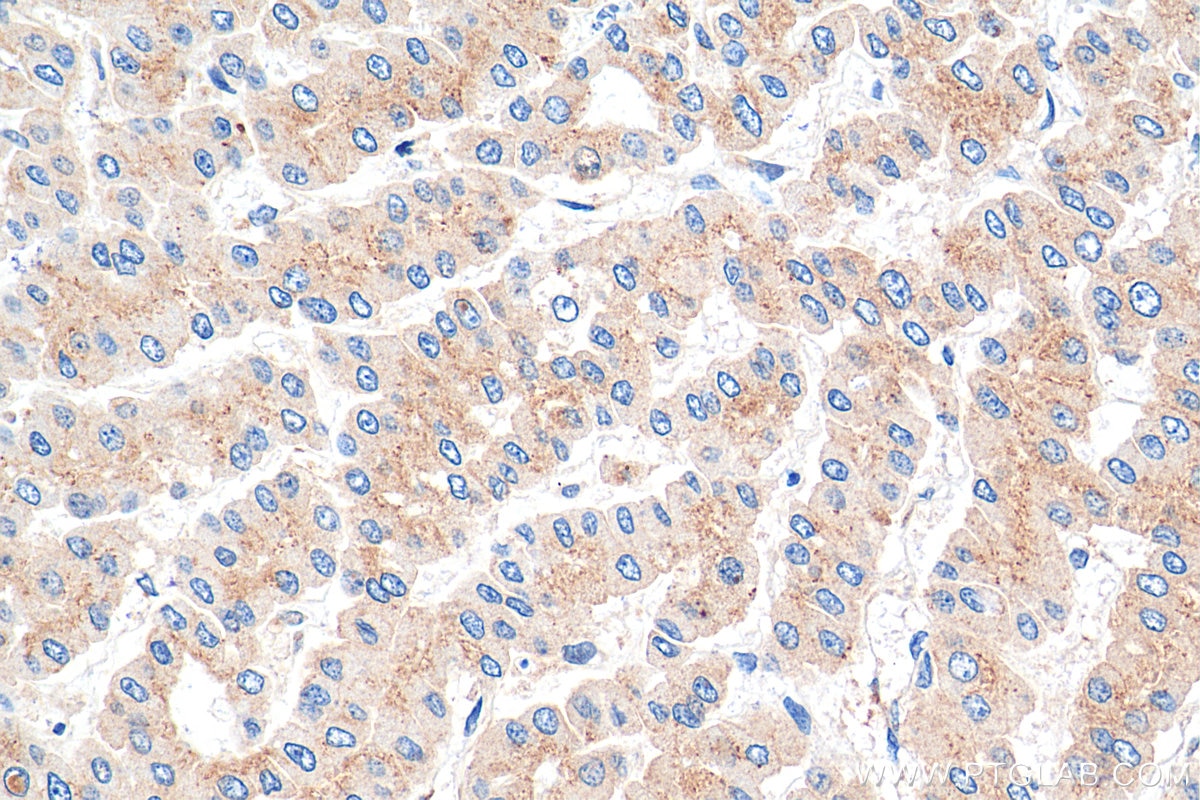 Immunohistochemistry (IHC) staining of human liver cancer tissue using p115, USO1 Monoclonal antibody (68100-1-Ig)