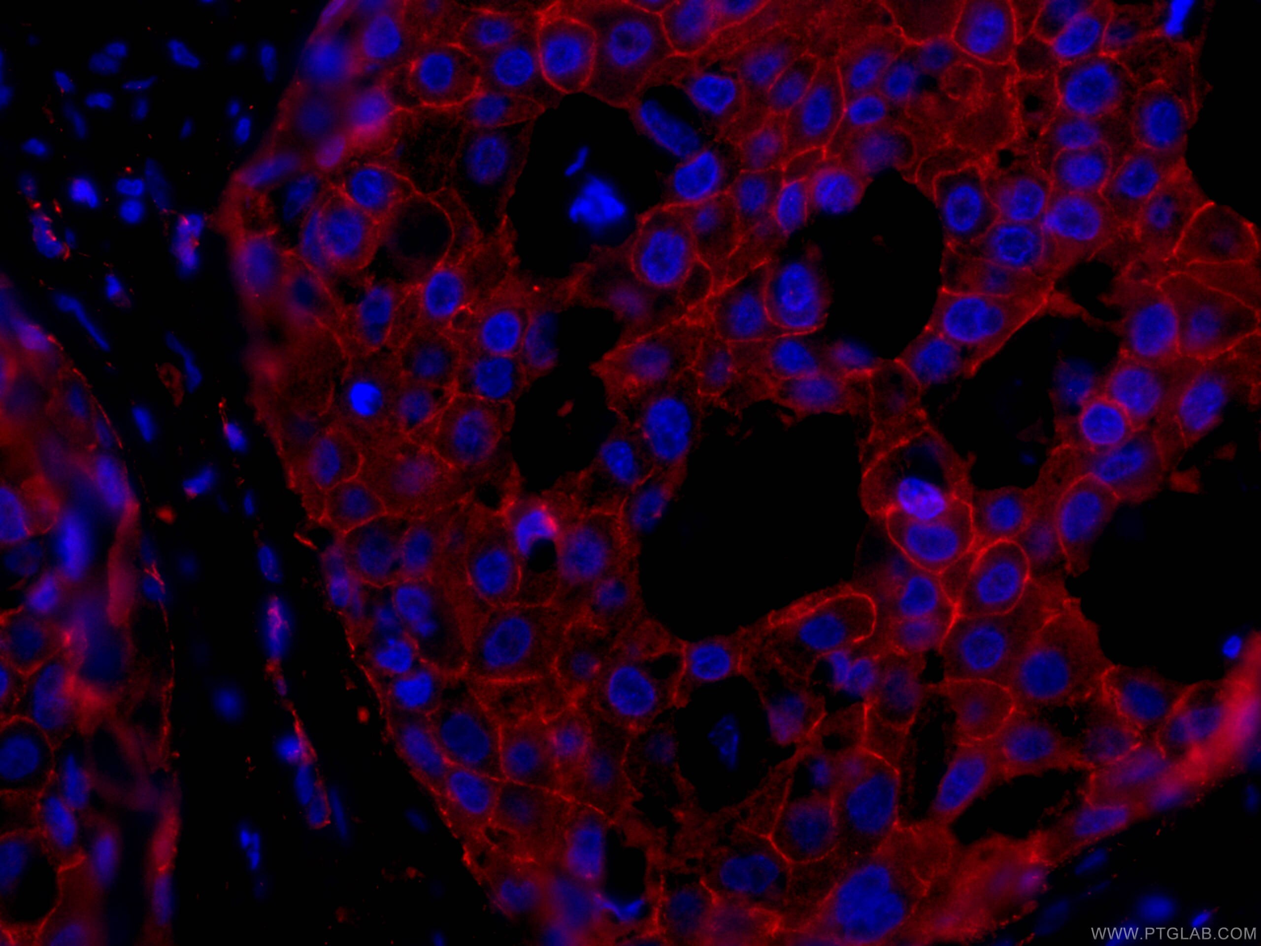 Immunofluorescence (IF) / fluorescent staining of human breast cancer tissue using CoraLite®594-conjugated p120 Catenin Monoclonal an (CL594-66208)