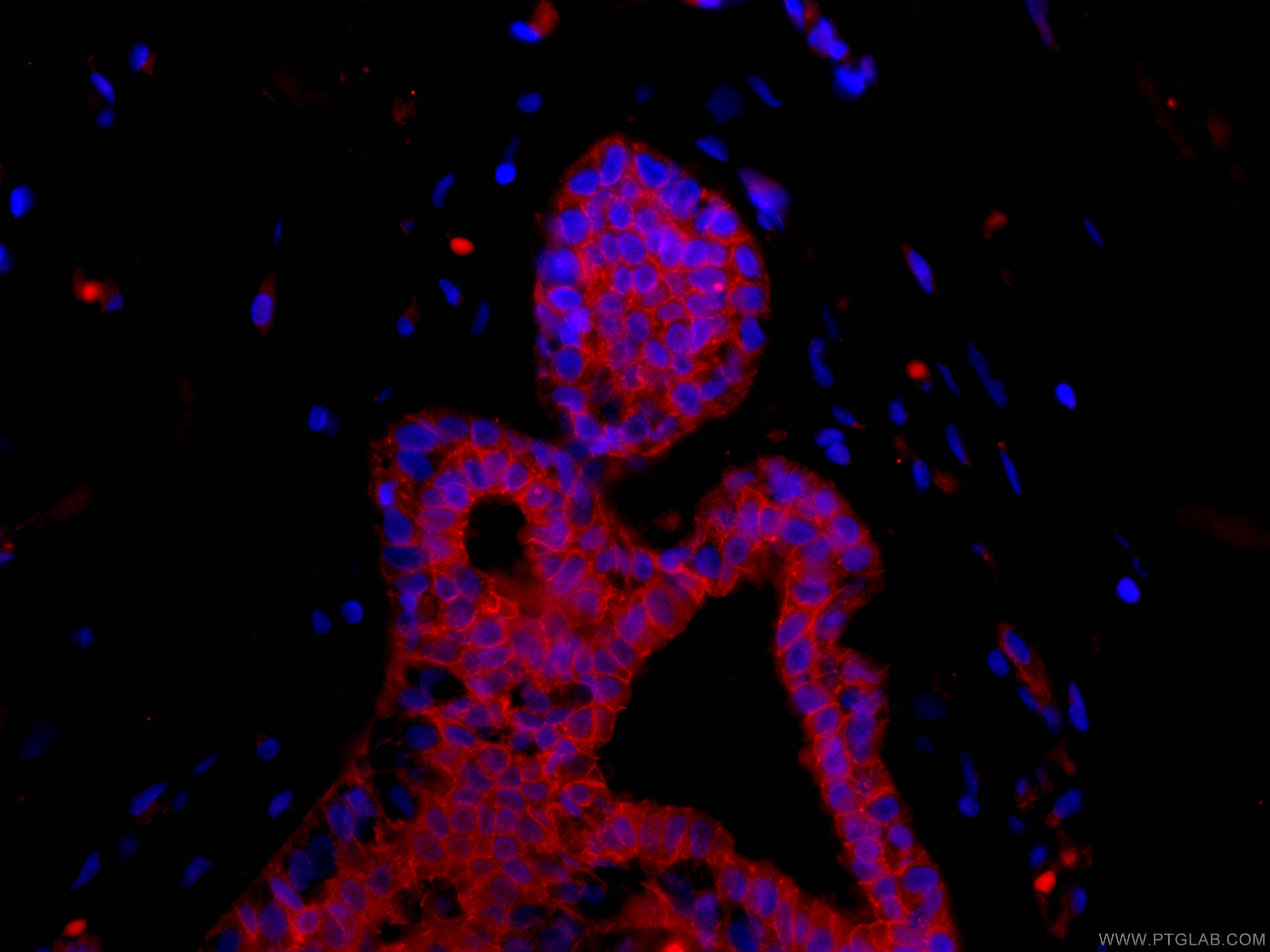 Immunofluorescence (IF) / fluorescent staining of human breast cancer tissue using CoraLite®594-conjugated p120 Catenin Monoclonal an (CL594-66208)