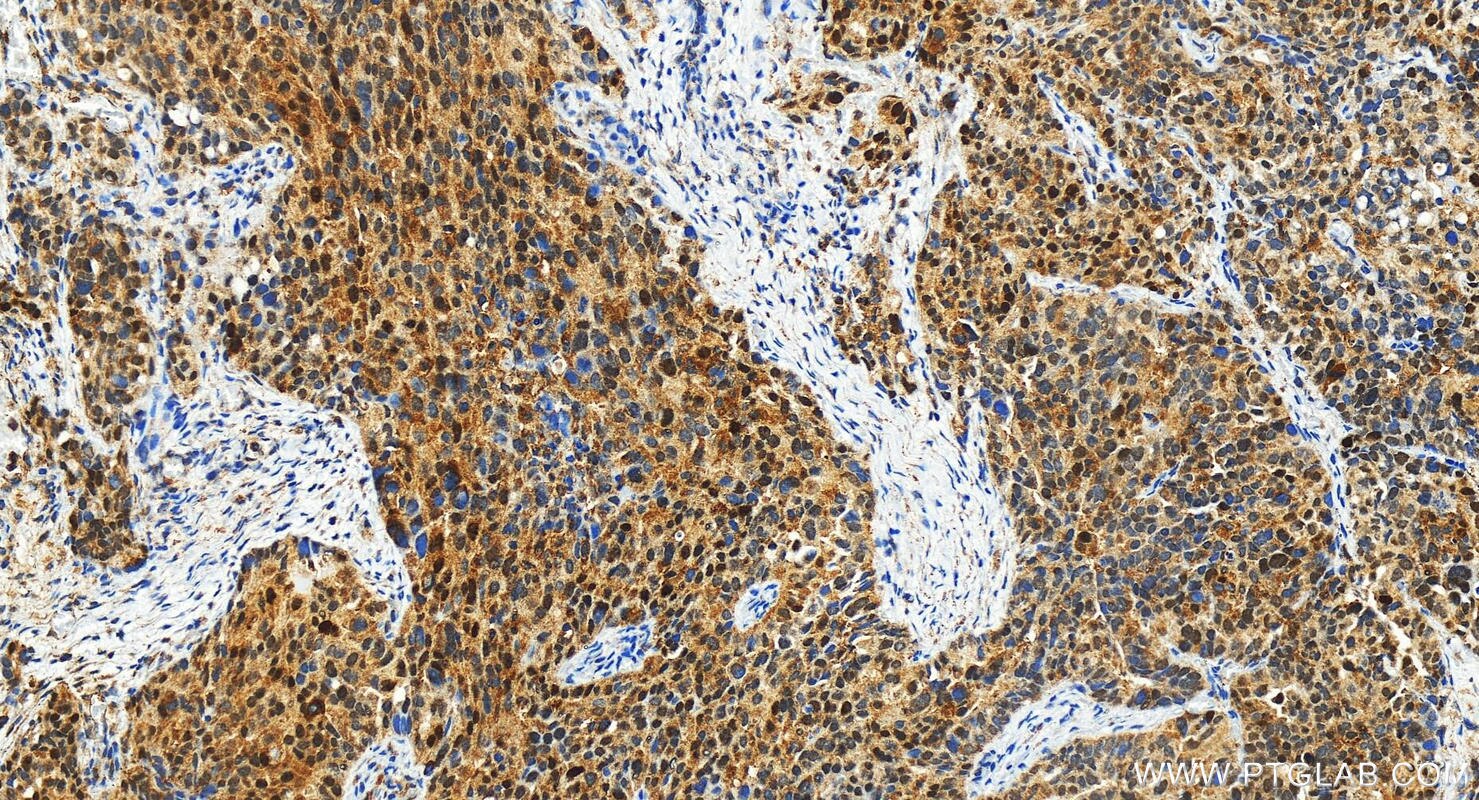 Immunohistochemistry (IHC) staining of human ovary cancer tissue using P14-ARF Polyclonal antibody (31221-1-AP)