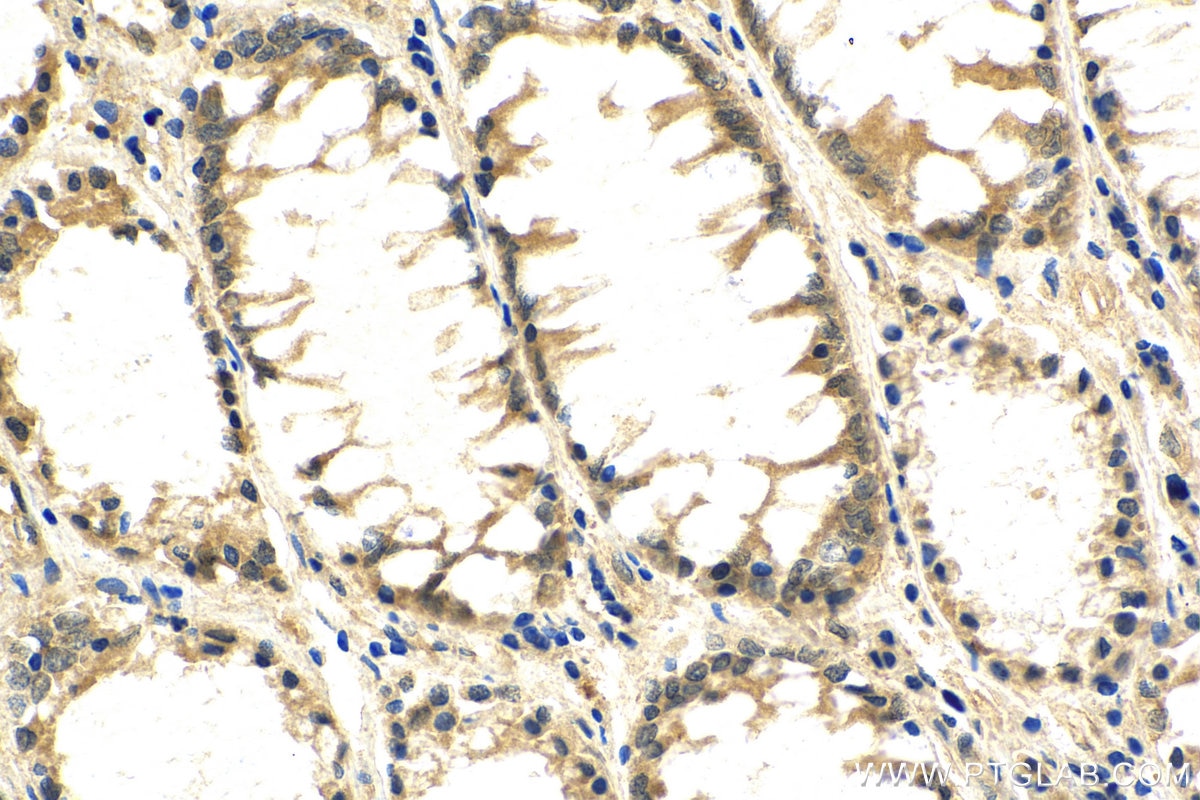 Immunohistochemistry (IHC) staining of human colon cancer tissue using p38 MAPK Polyclonal antibody (14064-1-AP)