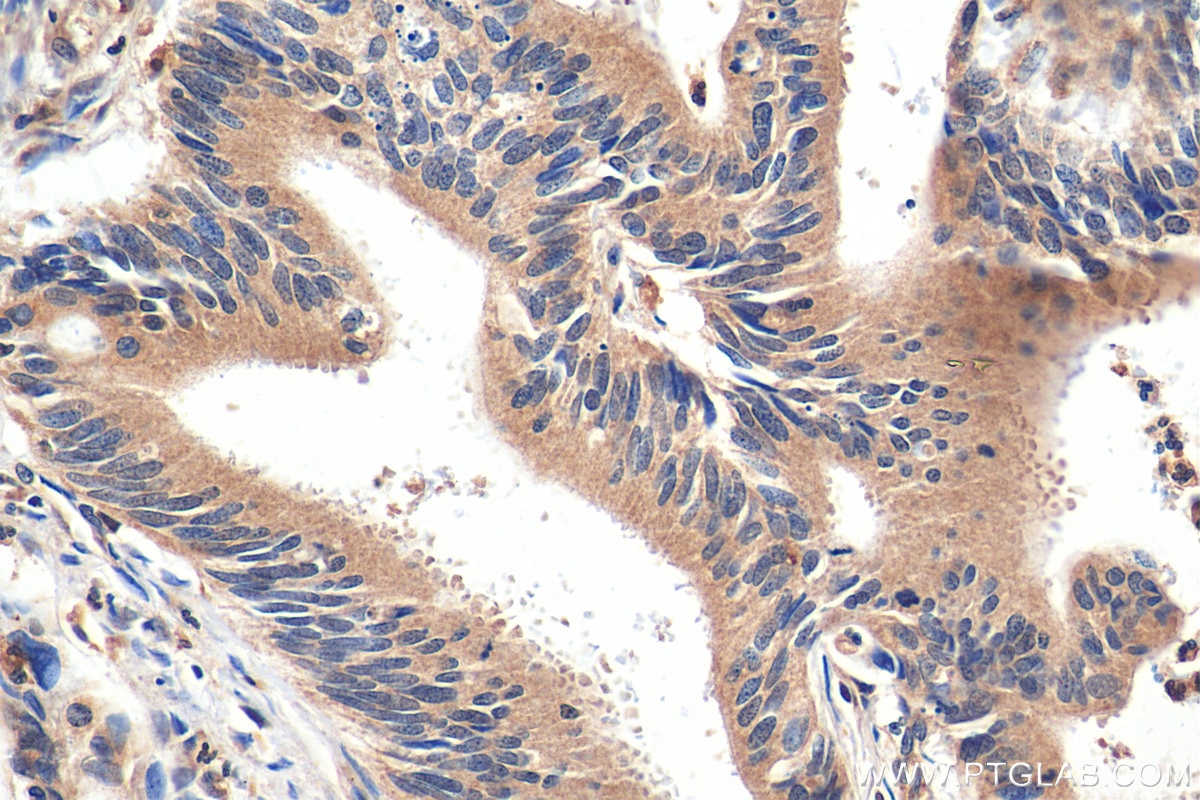 Immunohistochemistry (IHC) staining of human colon cancer tissue using p38 MAPK Polyclonal antibody (14064-1-AP)