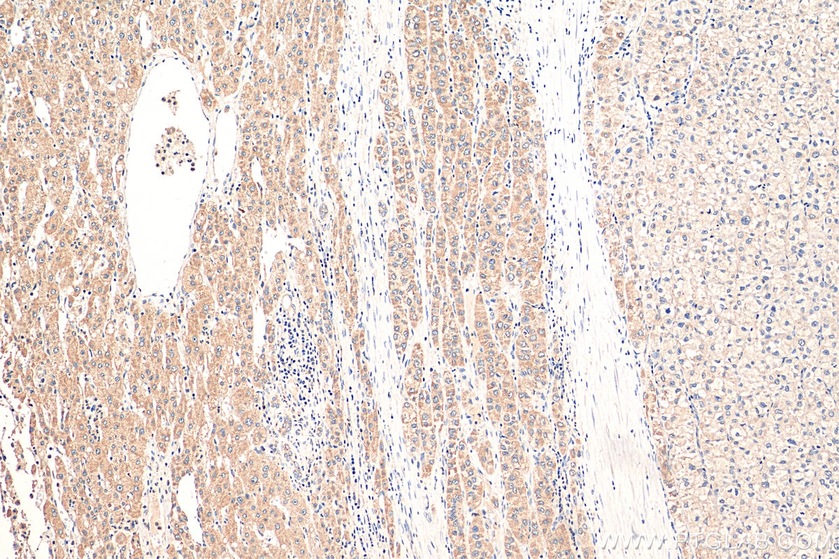 Immunohistochemistry (IHC) staining of human liver cancer tissue using p38 MAPK Polyclonal antibody (14064-1-AP)