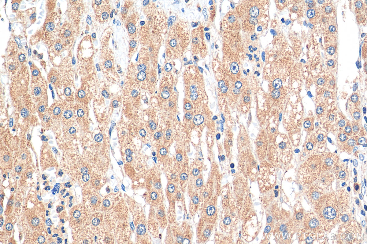 Immunohistochemistry (IHC) staining of human liver cancer tissue using p38 MAPK Polyclonal antibody (14064-1-AP)