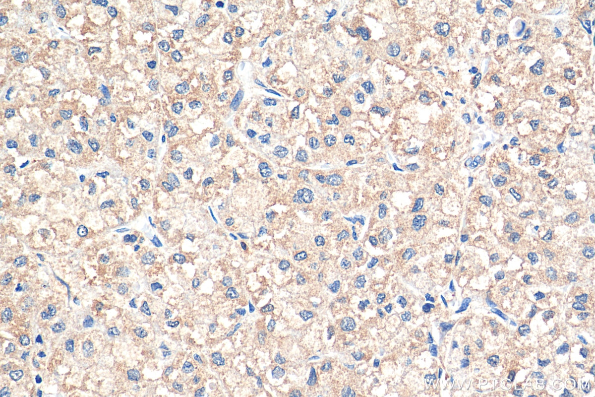 Immunohistochemistry (IHC) staining of human liver cancer tissue using p38 MAPK Polyclonal antibody (14064-1-AP)