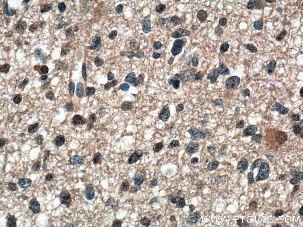 IHC staining of human gliomas using 66234-1-Ig