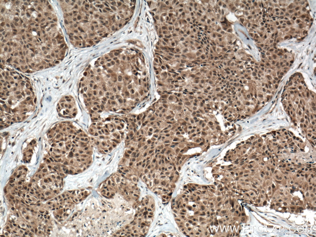 Immunohistochemistry (IHC) staining of human lung cancer tissue using p38 MAPK Monoclonal antibody (66234-1-Ig)