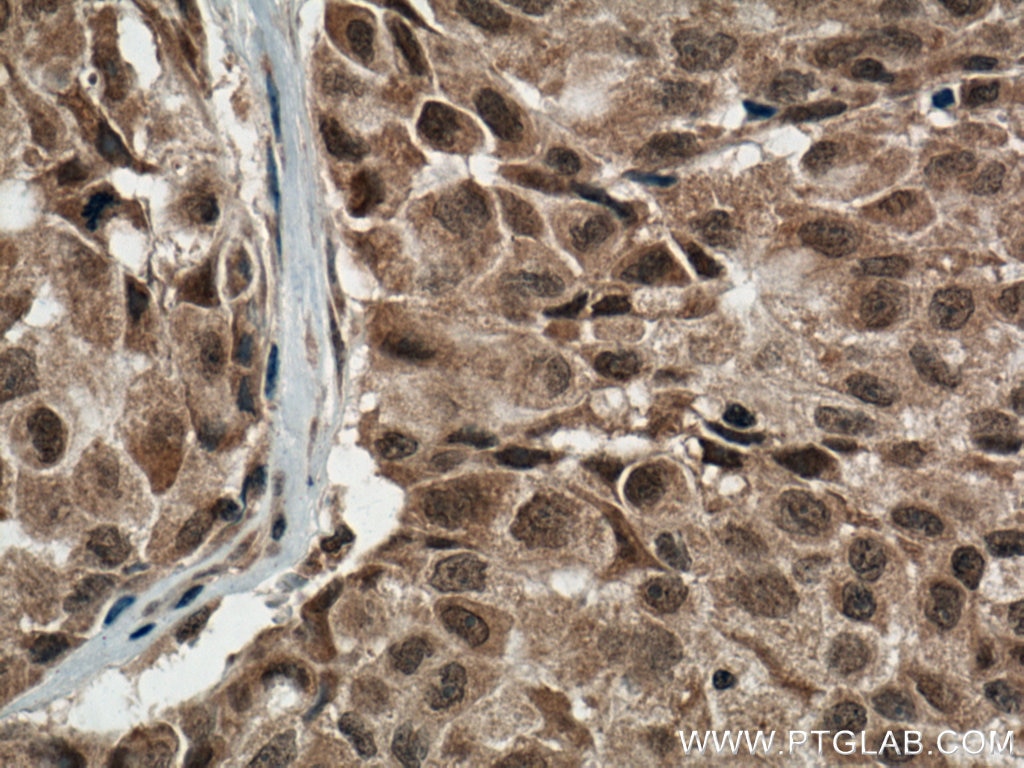 Immunohistochemistry (IHC) staining of human lung cancer tissue using p38 MAPK Monoclonal antibody (66234-1-Ig)