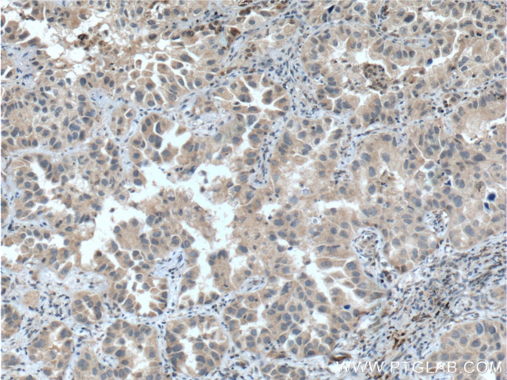 Immunohistochemistry (IHC) staining of human lung cancer tissue using p38 MAPK Monoclonal antibody (66234-1-Ig)