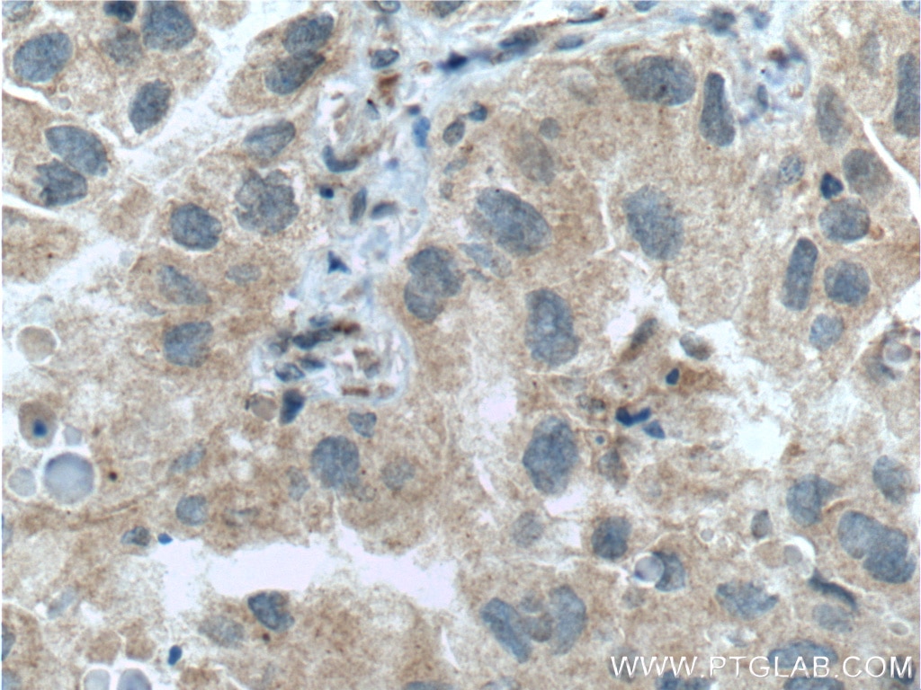 Immunohistochemistry (IHC) staining of human lung cancer tissue using p38 MAPK Monoclonal antibody (66234-1-Ig)