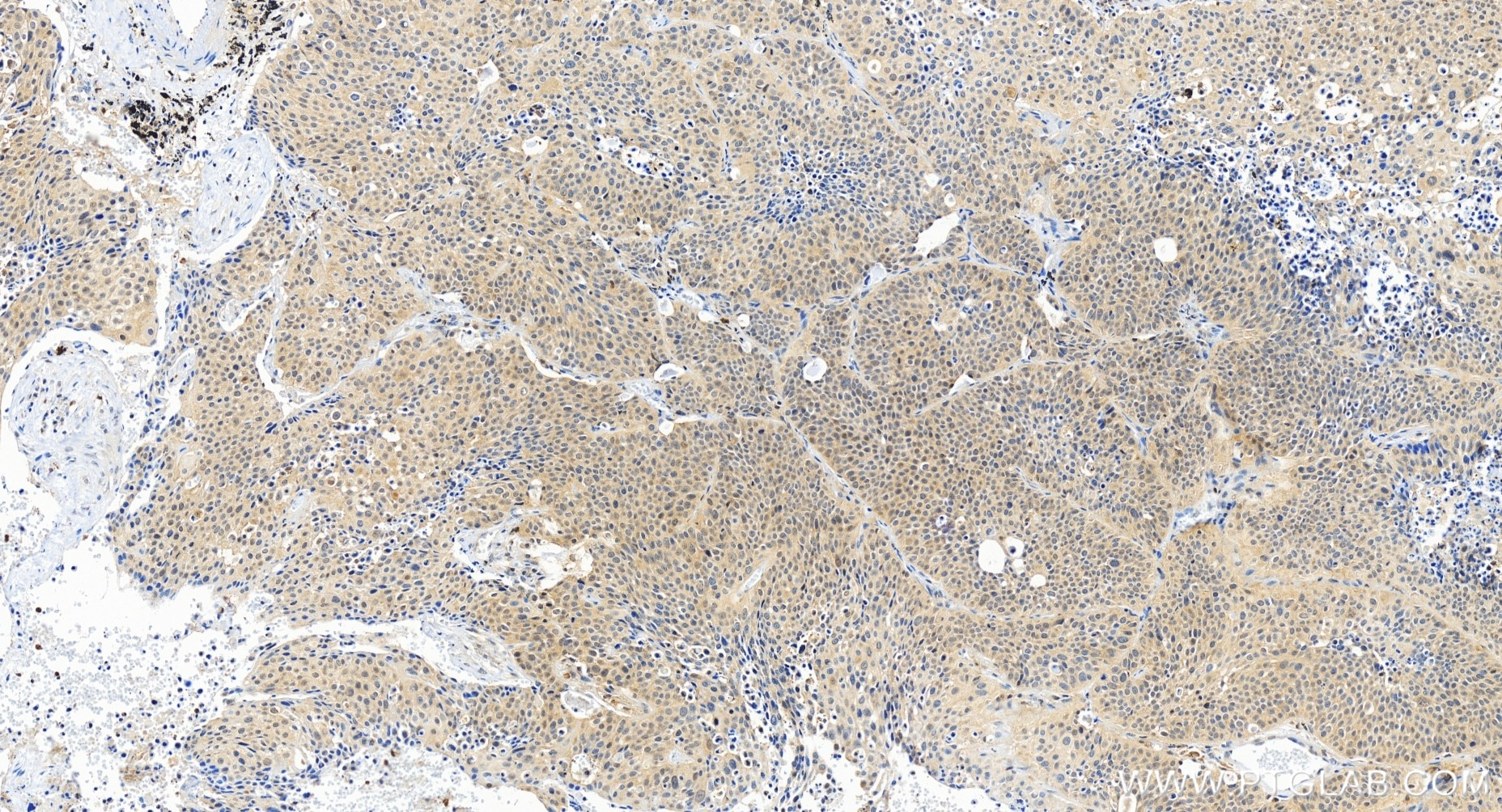 Immunohistochemistry (IHC) staining of human lung cancer tissue using p38 MAPK Recombinant antibody (80821-2-RR)