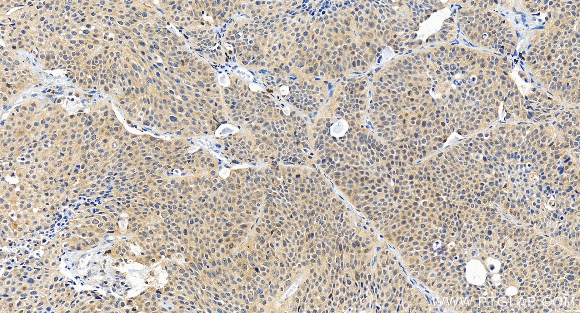 Immunohistochemistry (IHC) staining of human lung cancer tissue using p38 MAPK Recombinant antibody (80821-2-RR)