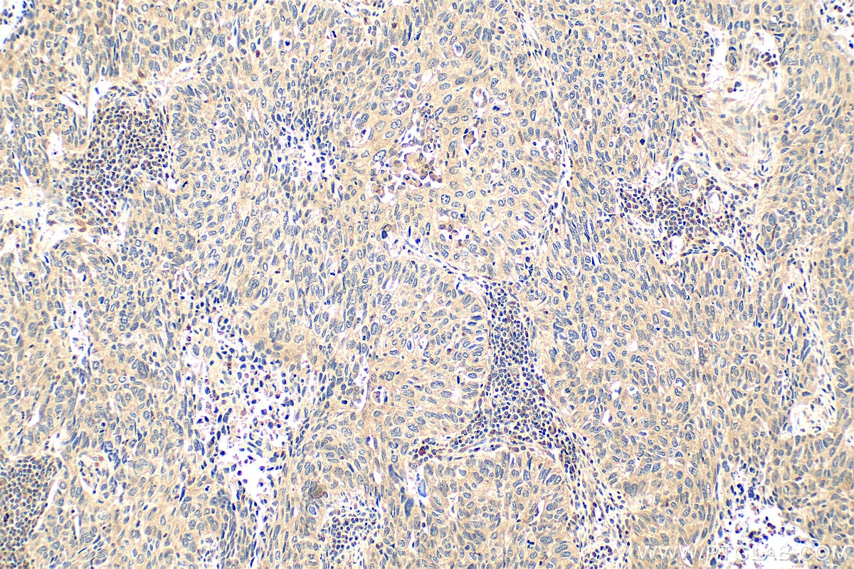 Immunohistochemistry (IHC) staining of human lung cancer tissue using Multi-rAb™ p38 MAPK Multi-Recombinant antibody (RMX00006)