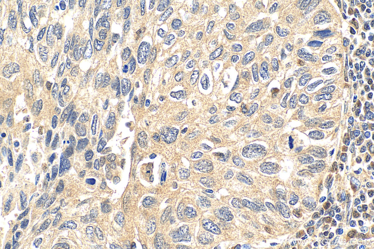 Immunohistochemistry (IHC) staining of human lung cancer tissue using Multi-rAb™ p38 MAPK Multi-Recombinant antibody (RMX00006)