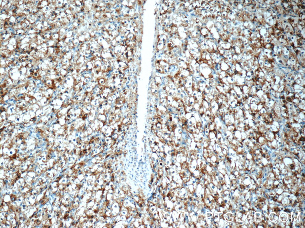 Immunohistochemistry (IHC) staining of human renal cell carcinoma tissue using AMACR/p504S Polyclonal antibody (15918-1-AP)