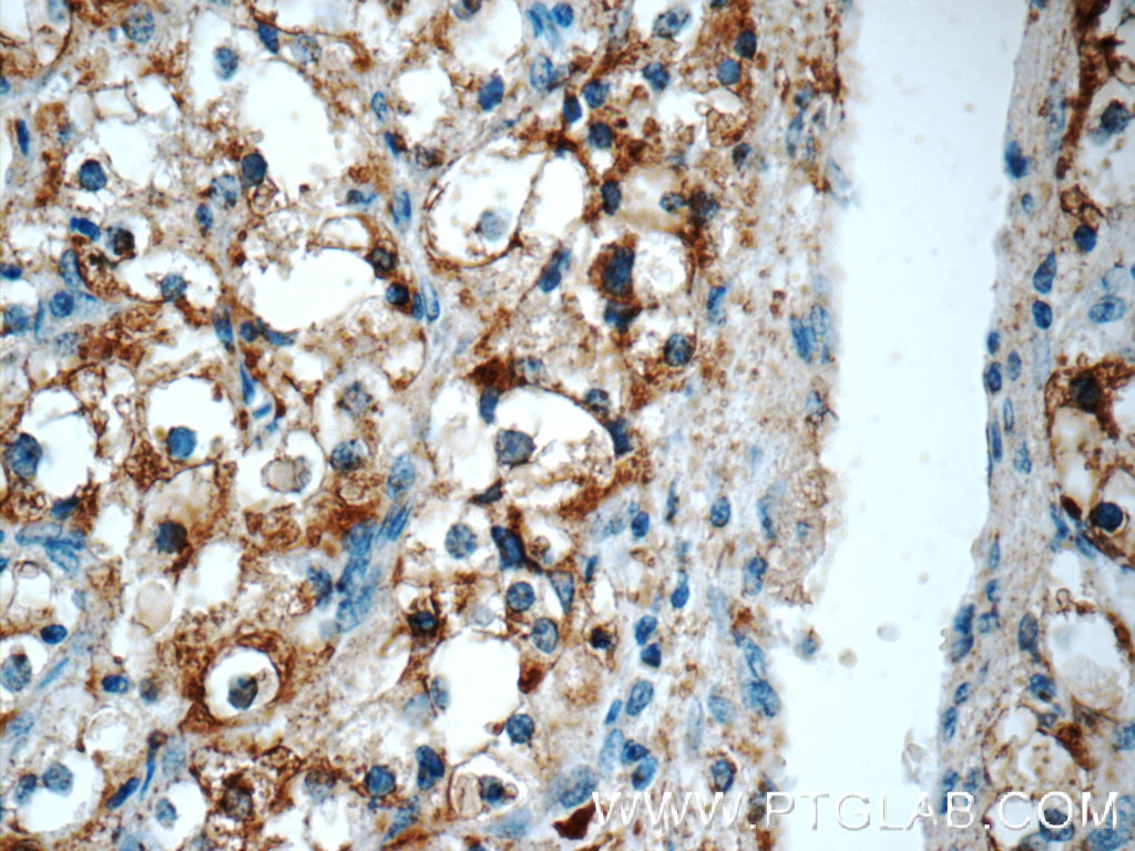 Immunohistochemistry (IHC) staining of human renal cell carcinoma tissue using AMACR/p504S Polyclonal antibody (15918-1-AP)