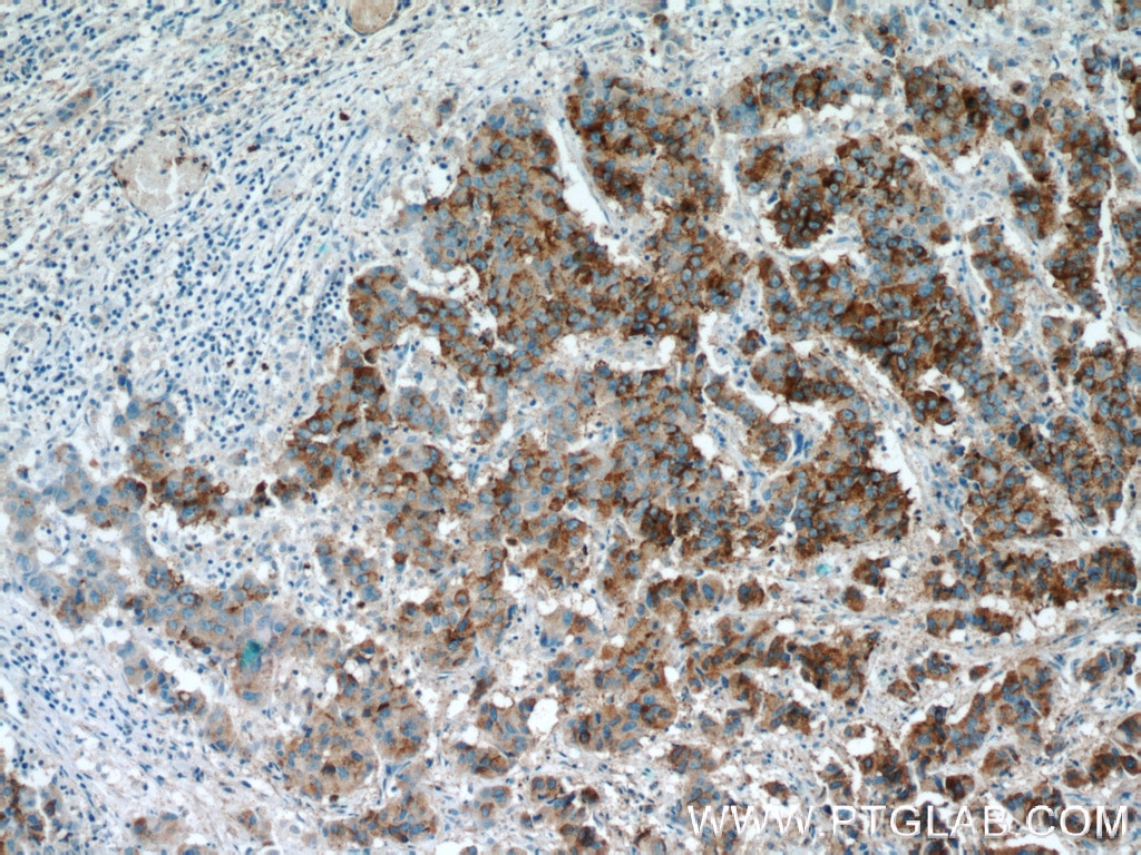 Immunohistochemistry (IHC) staining of human prostate cancer tissue using AMACR/p504S Polyclonal antibody (15918-1-AP)