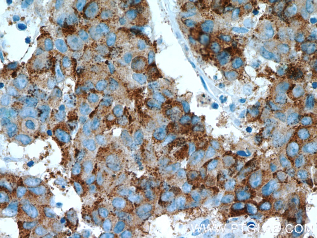 Immunohistochemistry (IHC) staining of human prostate cancer tissue using AMACR/p504S Polyclonal antibody (15918-1-AP)