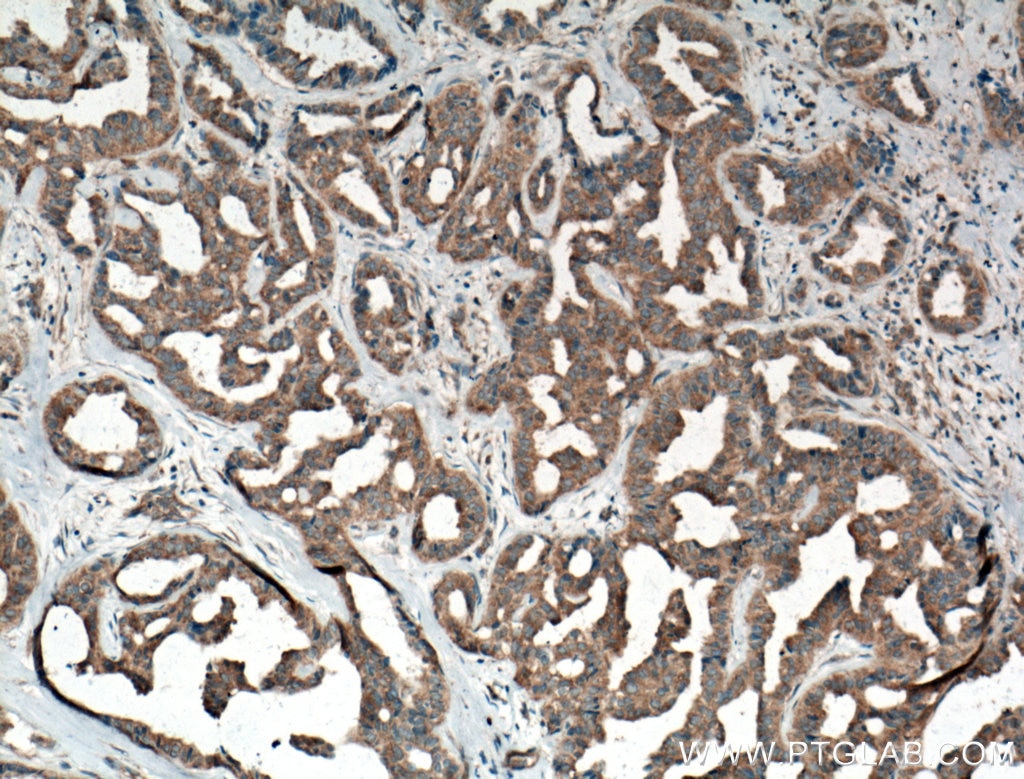 Immunohistochemistry (IHC) staining of human breast cancer tissue using NF-κB p65 Monoclonal antibody (66535-1-Ig)