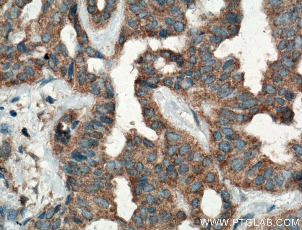 Immunohistochemistry (IHC) staining of human breast cancer tissue using NF-κB p65 Monoclonal antibody (66535-1-Ig)