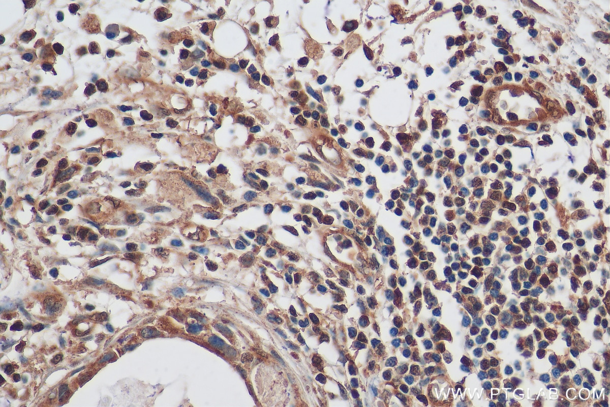 Immunohistochemistry (IHC) staining of human breast cancer tissue using NF-κB p65 Polyclonal antibody (10745-1-AP)