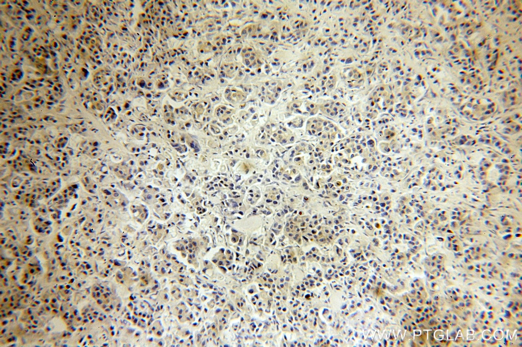Immunohistochemistry (IHC) staining of human breast cancer tissue using NF-κB p65 Polyclonal antibody (10745-1-AP)