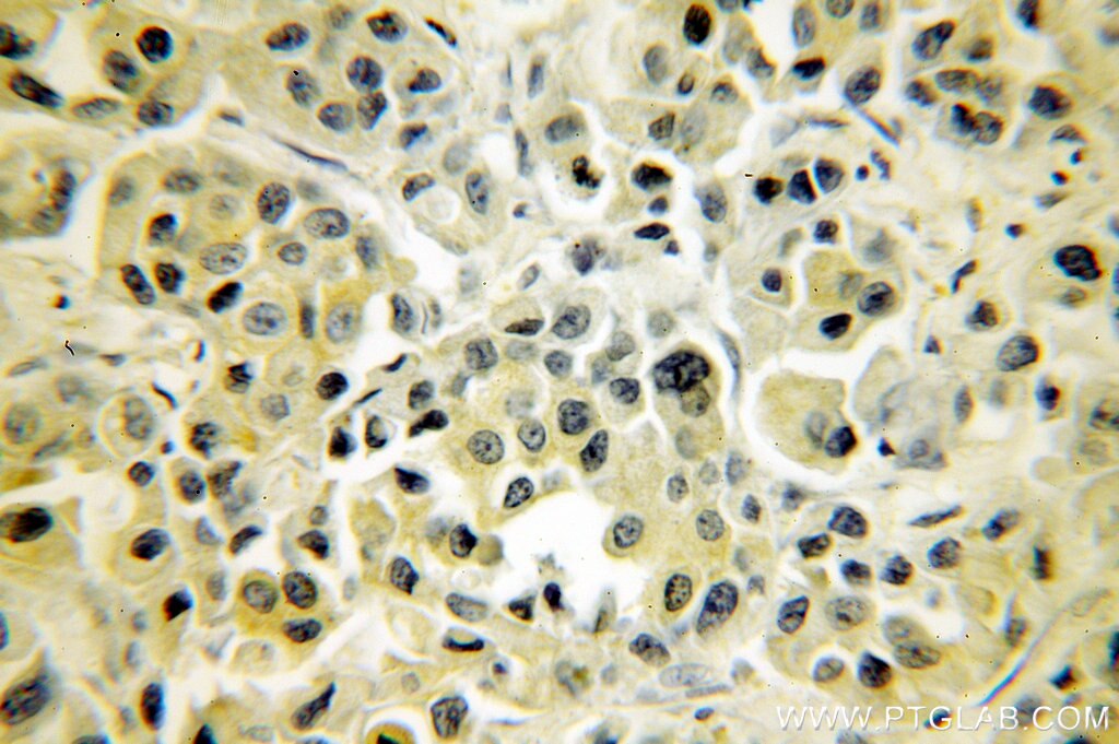 Immunohistochemistry (IHC) staining of human breast cancer tissue using NF-κB p65 Polyclonal antibody (10745-1-AP)