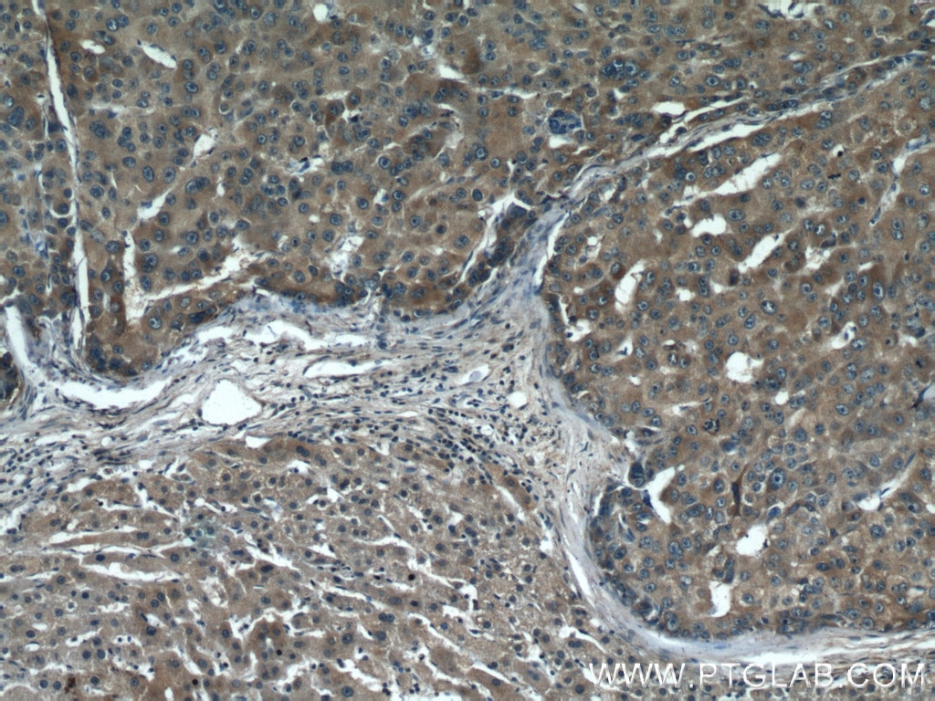 Immunohistochemistry (IHC) staining of human liver cancer tissue using NF-κB p65 Polyclonal antibody (10745-1-AP)