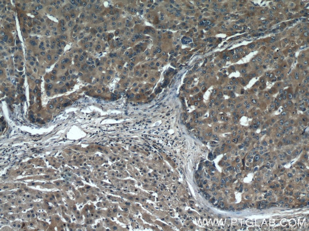 IHC staining of human liver cancer using 10745-1-AP