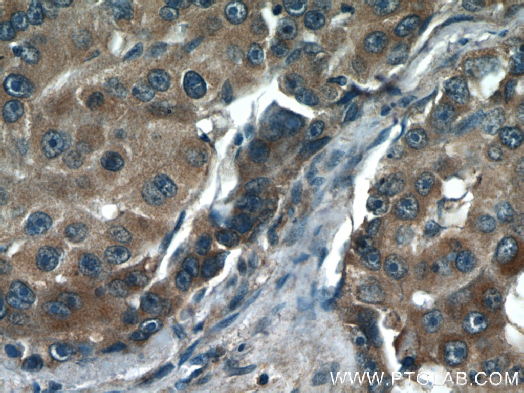 Immunohistochemistry (IHC) staining of human liver cancer tissue using NF-κB p65 Polyclonal antibody (10745-1-AP)