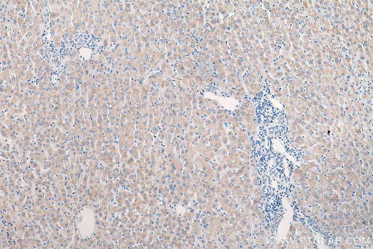 Immunohistochemistry (IHC) staining of human liver cancer tissue using p70(S6K) Polyclonal antibody (14485-1-AP)