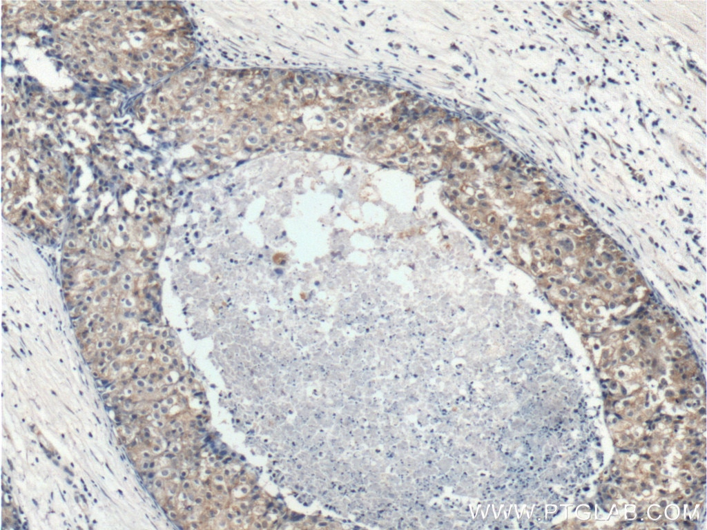 Immunohistochemistry (IHC) staining of human breast cancer tissue using p70(S6K) Polyclonal antibody (26587-1-AP)