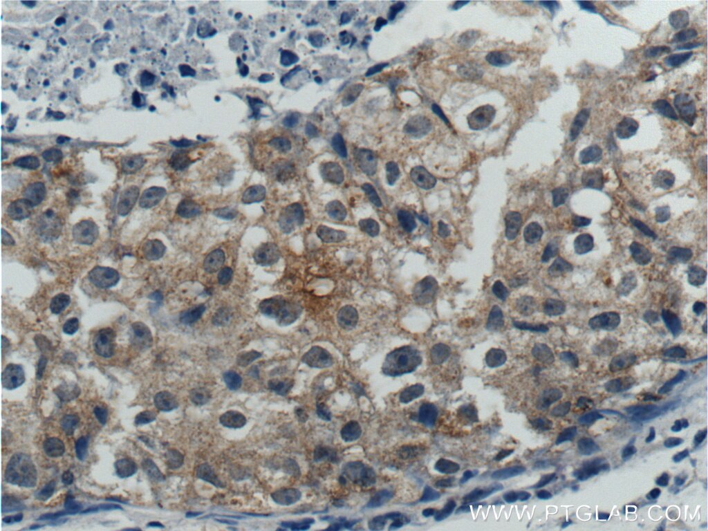 Immunohistochemistry (IHC) staining of human breast cancer tissue using p70(S6K) Polyclonal antibody (26587-1-AP)