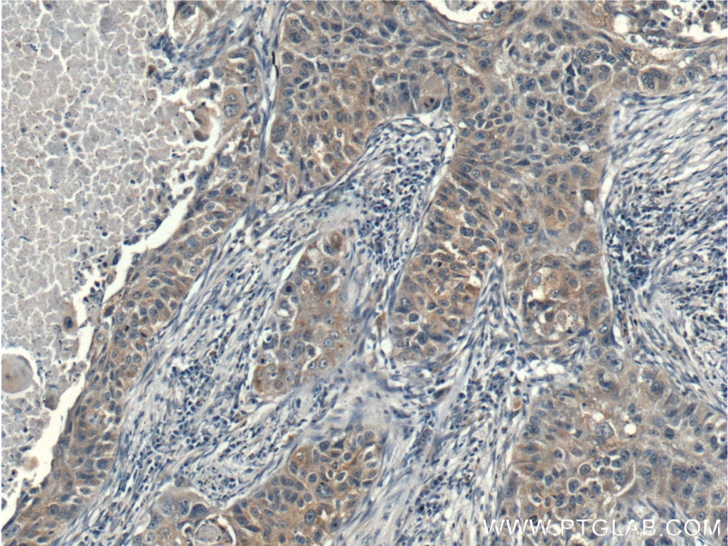 Immunohistochemistry (IHC) staining of human lung cancer tissue using p70(S6K) Polyclonal antibody (26587-1-AP)
