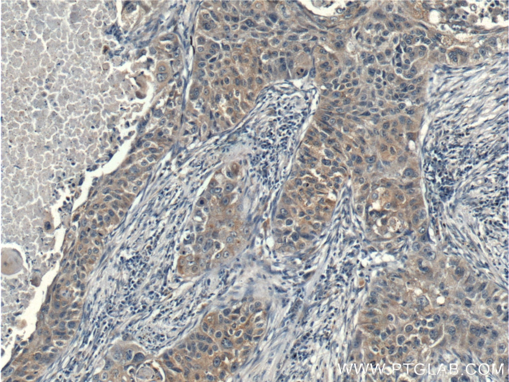 Immunohistochemistry (IHC) staining of human lung cancer tissue using p70(S6K) Polyclonal antibody (26587-1-AP)