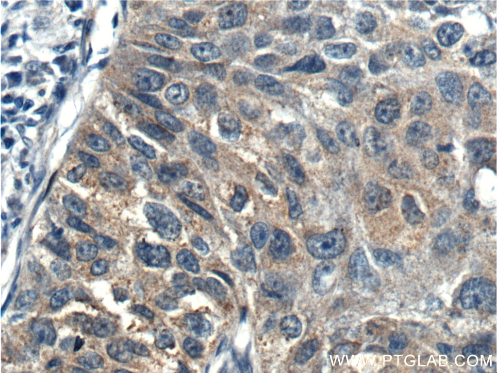 Immunohistochemistry (IHC) staining of human lung cancer tissue using p70(S6K) Polyclonal antibody (26587-1-AP)