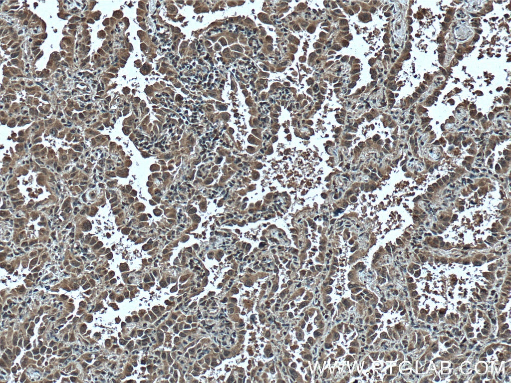 IHC staining of human lung cancer using 66638-1-Ig