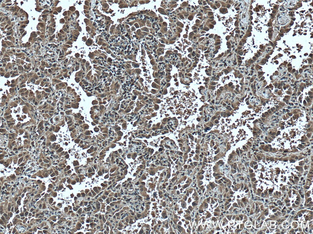 Immunohistochemistry (IHC) staining of human lung cancer tissue using p70(S6K) Monoclonal antibody (66638-1-Ig)