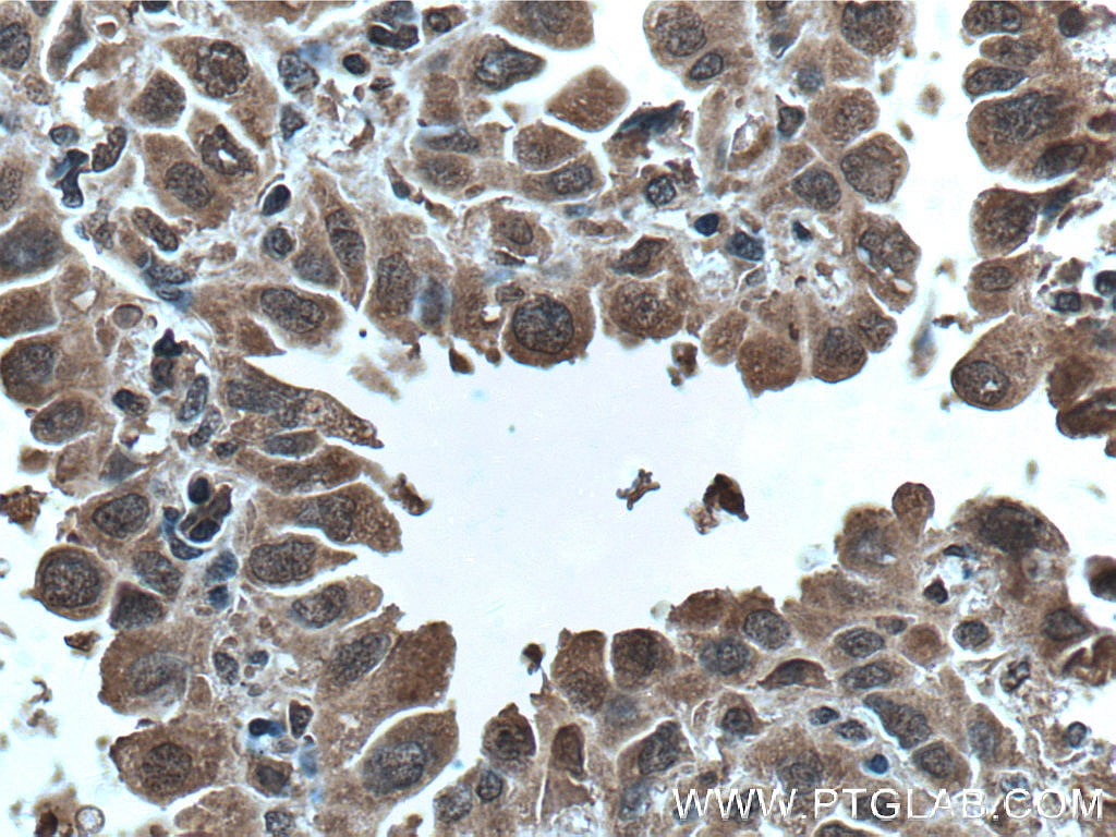 Immunohistochemistry (IHC) staining of human lung cancer tissue using p70(S6K) Monoclonal antibody (66638-1-Ig)