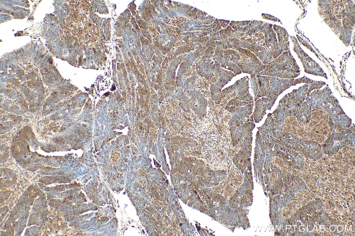 Immunohistochemistry (IHC) staining of human colon cancer tissue using AKT Polyclonal antibody (27809-1-AP)
