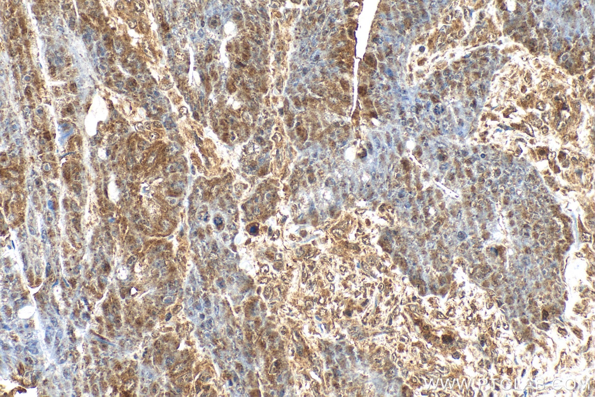 Immunohistochemistry (IHC) staining of human colon cancer tissue using AKT Polyclonal antibody (27809-1-AP)