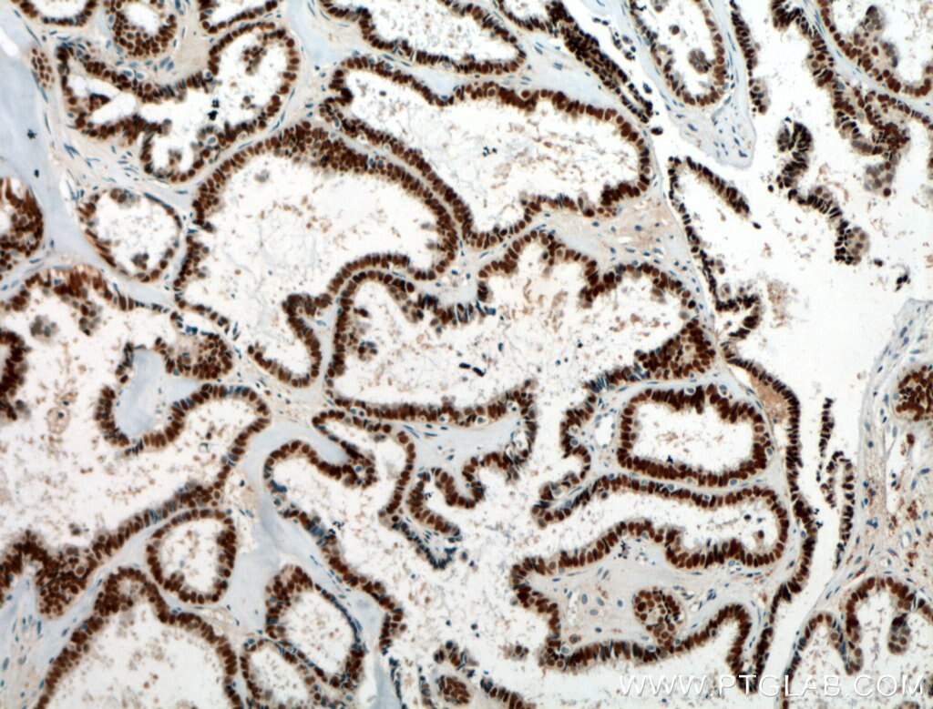 IHC staining of human ovary tumor using 21383-1-AP