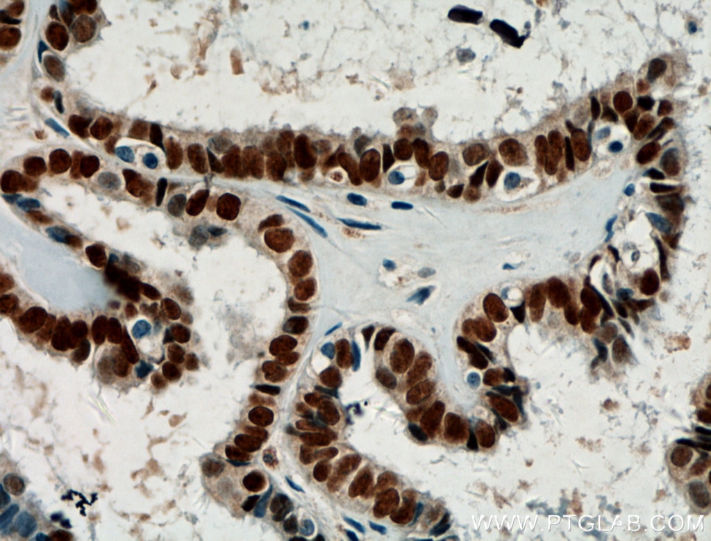 IHC staining of human ovary tumor using 21383-1-AP